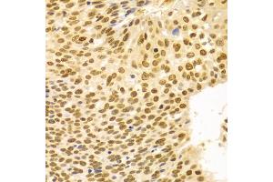 Immunohistochemistry of paraffin-embedded human esophageal cancer using DKC1 Antibody (ABIN5970956) at dilution of 1/100 (40x lens). (DKC1 Antikörper)