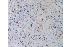 IHC-P analysis of Human Stomach Cancer Tissue, with DAB staining. (TPSAB1 Antikörper  (AA 161-262))