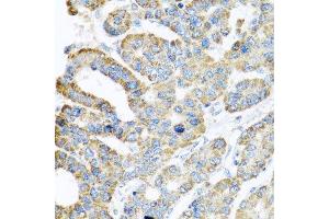 Immunohistochemistry of paraffin-embedded human liver cancer using ATPIF1 antibody. (ATPase Inhibitory Factor 1 Antikörper  (AA 26-106))