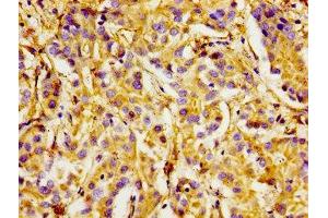 Immunohistochemistry of paraffin-embedded human liver cancer using ABIN7156425 at dilution of 1:100 (Integrin alpha 1 Antikörper  (AA 242-524))