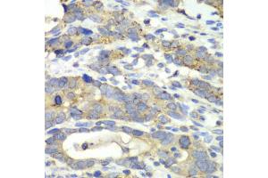 Immunohistochemistry of paraffin-embedded human gastric cancer using CHMP2B antibody.