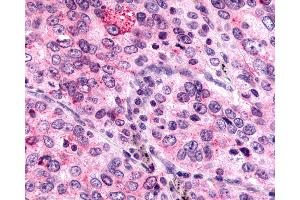 Anti-MRGPRX4 / MRGX4 antibody IHC of human Lung, Non-Small Cell Carcinoma. (MRGPRX4 Antikörper  (N-Term))