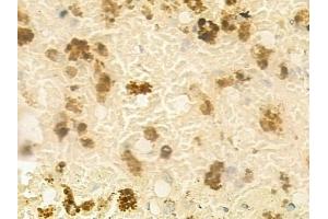 ABIN6262146 and ABIN6266710 at 1/100 staining human melanoma by IHC-P.