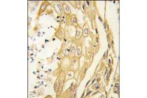 Formalin-fixed and paraffin-embedded human lung carcinoma tissue reacted with the EphB4 antibody, which was peroxidase-conjugated to the secondary antibody, followed by DAB staining. (EPH Receptor B4 Antikörper)