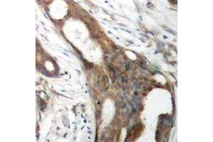 Immunohistochemical analysis of ASCT1 staining in human ovarian cancer formalin fixed paraffin embedded tissue section. (SLC1A4 Antikörper)