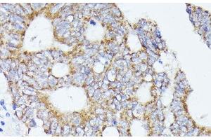 Immunohistochemistry of paraffin-embedded Human colon carcinoma using ACAT2 Polyclonal Antibody at dilution of 1:100 (40x lens). (ACAT2 Antikörper)