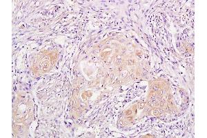 Formalin-fixed and paraffin embedded human endometrial cancer labeled with Anti-phospho-CDKN1A/P21 (Thr57) Polyclonal Antibody, Unconjugated (ABIN756877) followed by conjugation to the secondary antibody and DAB staining (p21 Antikörper  (pThr57))