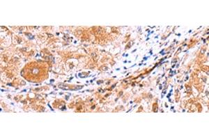 Immunohistochemistry of paraffin-embedded Human liver cancer tissue using IRGC Polyclonal Antibody at dilution of 1:30(x200) (IRGC Antikörper)