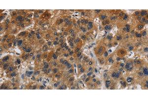 Immunohistochemistry of paraffin-embedded Human liver cancer tissue using Claudin 8 Polyclonal Antibody at dilution 1:50 (CLDN8 Antikörper)