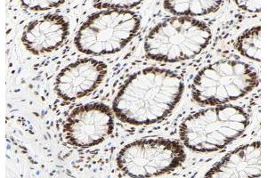 ABIN6267330 at 1/200 staining human colon carcinoma tissue sections by IHC-P. (HNRNPC Antikörper  (pSer260))