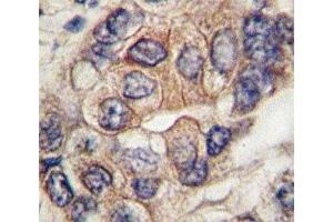IHC analysis of FFPE human hepatocarcinoma tissue stained with PDGFR antibody