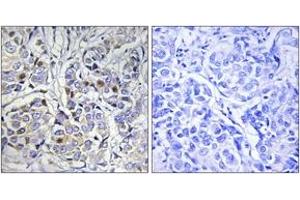 Immunohistochemistry analysis of paraffin-embedded human breast carcinoma tissue, using Centromeric Protein A (Ab-7) Antibody. (CENPA Antikörper  (AA 1-50))
