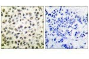 Immunohistochemical analysis of paraffin-embedded human colon carcinoma tissue using STAT5B (Ab-731) antibody. (STAT5B Antikörper  (Ser731))