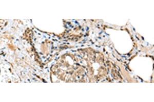 Immunohistochemistry of paraffin-embedded Human thyroid cancer tissue using TPPP Polyclonal Antibody at dilution of 1:25(x200) (Tppp Antikörper)