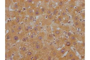 IHC image of ABIN7144415 diluted at 1:200 and staining in paraffin-embedded human liver cancer performed on a Leica BondTM system. (APOC1 Antikörper  (AA 35-48))