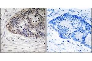 Immunohistochemistry analysis of paraffin-embedded human colon carcinoma, using MDM4 (Phospho-Ser367) Antibody. (MDM4-binding Protein Antikörper  (pSer367))