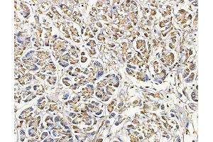 ABIN6265341 and ABIN6279794 at 1/100 staining human pancreatic cancer by IHC-P. (STK25 Antikörper  (Internal Region))