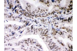 Anti- DAXX Picoband antibody,IHC(P) IHC(P): Human Intestinal Cancer Tissue (DAXX Antikörper  (AA 56-345))