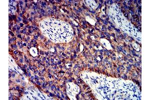 Immunohistochemical analysis of paraffin-embedded cervical cancer tissues using CTNNB1 mouse mAb with DAB staining. (CTNNB1 Antikörper  (AA 1-100))