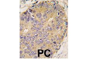 Formalin-fixed and paraffin-embedded human prostate carcinoma tissue reacted with BMP15 polyclonal antibody  , which was peroxidase-conjugated to the secondary antibody, followed by DAB staining. (BMP15 Antikörper  (Internal Region))