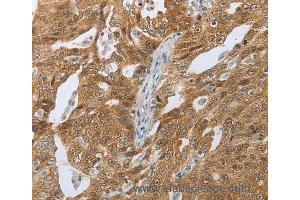 Immunohistochemistry of Human ovarian cancer using CEBPA Polyclonal Antibody at dilution of 1:40 (CEBPA Antikörper)