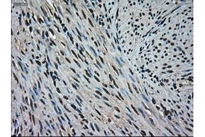 Immunohistochemical staining of paraffin-embedded Adenocarcinoma of colon tissue using anti-MAPK1mouse monoclonal antibody. (ERK2 Antikörper)