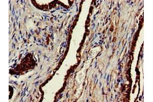 Immunohistochemistry of paraffin-embedded human prostate cancer using ABIN7147854 at dilution of 1:100 (CLINT1 Antikörper  (AA 1-625))