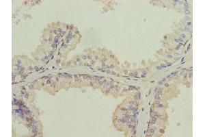 Immunohistochemistry of paraffin-embedded human prostate cancer using ABIN7157054 at dilution of 1:100 (ISCA2 Antikörper  (AA 9-154))