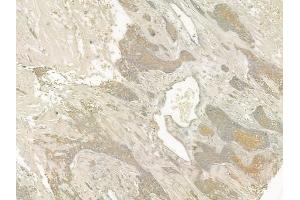ABIN6260525 and ABIN6273205 at 1/100 staining human breast carcinoma by IHC-P.