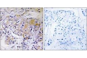 Immunohistochemistry analysis of paraffin-embedded human breast carcinoma tissue, using ULK3 Antibody. (ULK3 Antikörper  (AA 141-190))