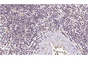 ABIN6273050 at 1/100 staining Human lymph cancer tissue by IHC-P. (IFT52 Antikörper  (Internal Region))
