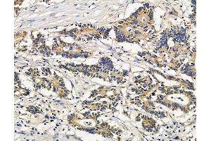 ABIN7096110 and ABIN7100172 at 1/100 staining human colorectal cancer by IHC-P. (LAPTM5 Antikörper)