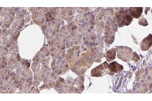 ABIN6273269 at 1/100 staining Human pancreas cancer tissue by IHC-P.
