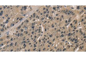 Immunohistochemistry of paraffin-embedded Human liver cancer tissue using CCAR1 Polyclonal Antibody at dilution 1:40 (CCAR1 Antikörper)