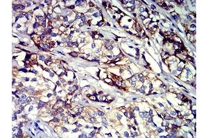 Immunohistochemical analysis of paraffin-embedded bladder cancer tissues using CD61 mouse mAb with DAB staining.