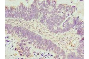 Immunohistochemistry of paraffin-embedded human ovarian cancer using ABIN7150033 at dilution of 1:100 (DAAM2 Antikörper  (AA 1-86))