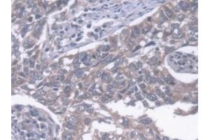 Detection of ERLIN2 in Human Lung cancer Tissue using Polyclonal Antibody to Endoplasmic Reticulum Lipid Raft Associated Protein 2 (ERLIN2) (ERLIN2 Antikörper  (AA 47-339))