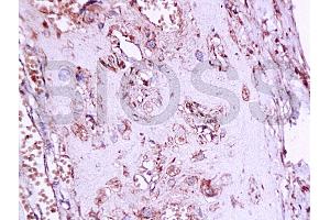 Formalin-fixed and paraffin embedded human placenta tissue labeledwith Anti-Phospho-Estrogen Receptor alpha (Ser167) Polyclonal Antibody, Unconjugated (ABIN729493) at 1:200, followed by conjugation to the secondary antibody and DAB staining (Estrogen Receptor alpha Antikörper  (pSer167))