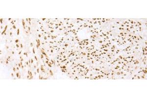 Immunohistochemistry of paraffin-embedded Human liver cancer tissue using TCOF1 Polyclonal Antibody at dilution of 1:50(x200) (TCOF1 Antikörper)