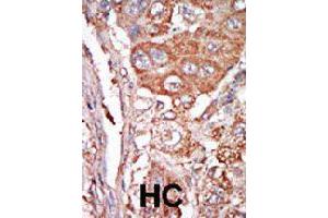 Formalin-fixed and paraffin-embedded human hepatocellular carcinoma tissue reacted with FGF4 polyclonal antibody  , which was peroxidase-conjugated to the secondary antibody, followed by DAB staining. (FGF4 Antikörper  (C-Term))