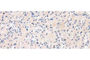 Immunohistochemistry of paraffin-embedded Human liver cancer tissue using MUC7 Polyclonal Antibody at dilution 1:30 (MUC7 Antikörper)