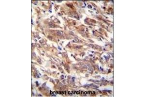 FBXW12 Antibody (C-term) (ABIN654226 and ABIN2844060) immunohistochemistry analysis in formalin fixed and paraffin embedded human breast carcinoma followed by peroxidase conjugation of the secondary antibody and DAB staining. (FBXW12 Antikörper  (C-Term))