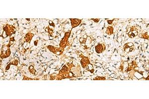 Immunohistochemistry of paraffin-embedded Human liver cancer tissue using C11orf54 Polyclonal Antibody at dilution of 1:50(x200) (C11orf54 Antikörper)