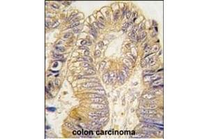 Formalin-fixed and paraffin-embedded human colon carcinoma tissue reacted with CLIC5 antibody (ABIN391843 and ABIN2841681) , which was peroxidase-conjugated to the secondary antibody, followed by DAB staining. (CLIC5 Antikörper)