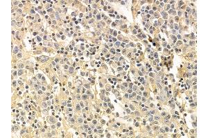 SGK1 Mouse Monoclonal Antibody at 1/100 staining human gastric cancer by IHC-P.