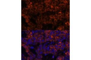 Immunofluorescence analysis of human liver cancer using PAI-1/Serpin E1 Polyclonal Antibody (ABIN6131330, ABIN6147601, ABIN6147603 and ABIN6221802) at dilution of 1:100 (40x lens). (PAI1 Antikörper  (AA 24-402))