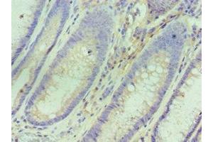 Immunohistochemistry of paraffin-embedded human colon cancer using ABIN7156763 at dilution of 1:100 (IL1RN Antikörper  (AA 22-230))