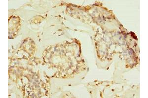 Immunohistochemistry of paraffin-embedded human breast cancer using ABIN7155221 at dilution of 1:100