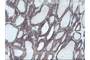 Immunohistochemical staining of paraffin-embedded Carcinoma of Human thyroid tissue using anti-C20orf3 mouse monoclonal antibody. (APMAP Antikörper)