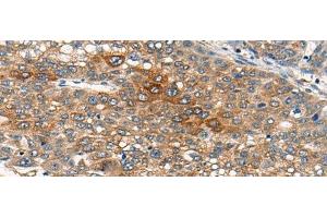 Immunohistochemistry of paraffin-embedded Human liver cancer tissue using B4GAT1 Polyclonal Antibody at dilution of 1:110(x200) (B3GNT1 Antikörper)